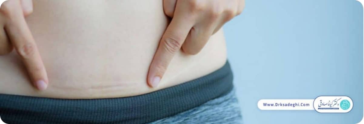 خطرات سزارین