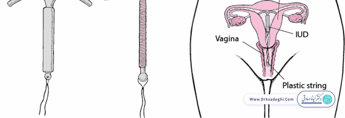 دستگاه داخل رحمی حاوی پروژسترون (IUD)