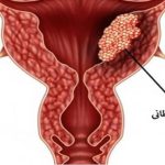شایع ترین سرطان های زنان همراه با علائم