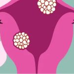 از کجا بفهمیم عفونت واژن داریم؟